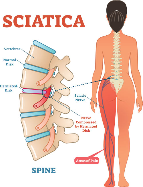 sciatica treatment